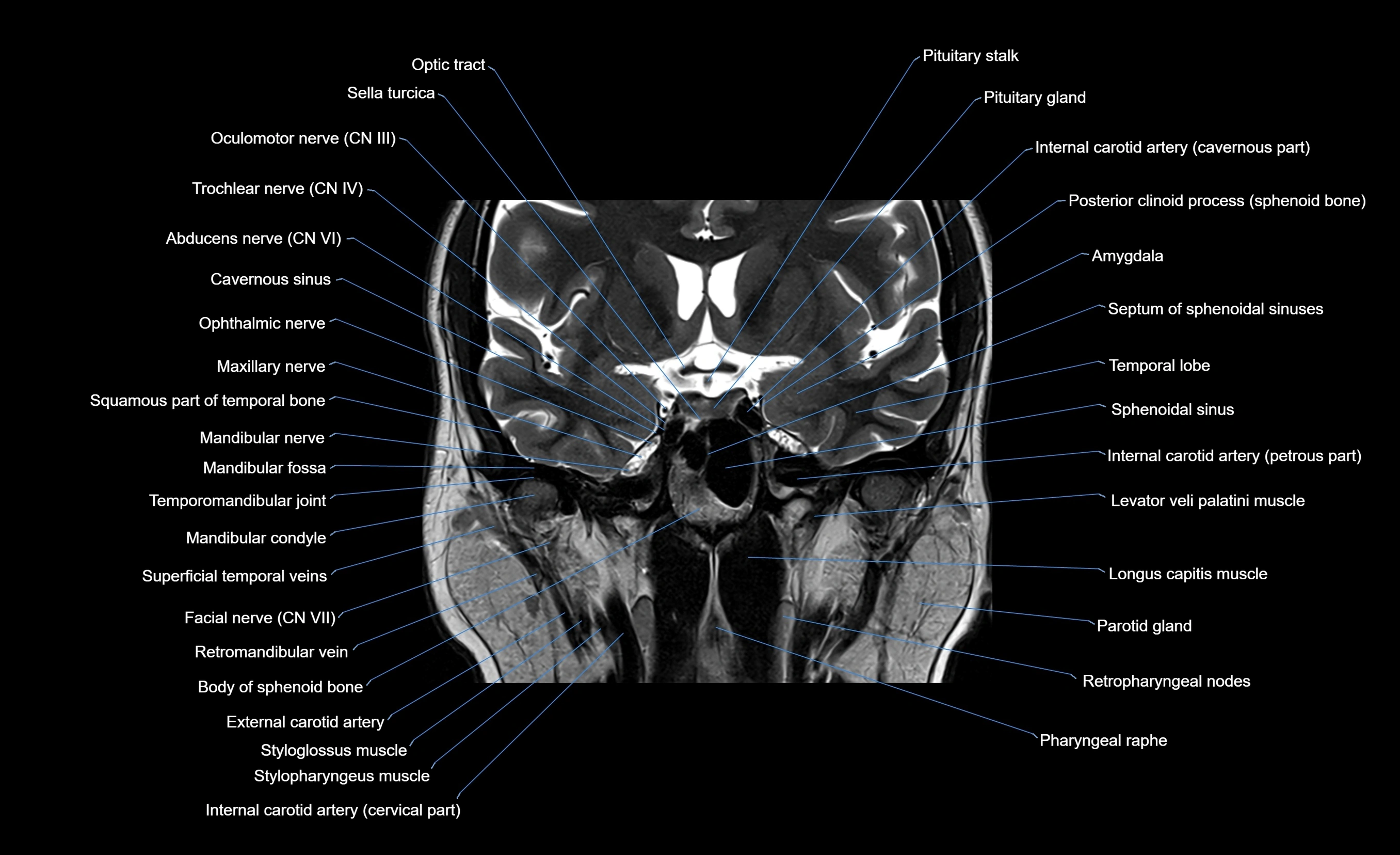MRI face & paranasal sinuses(PNS) labelled  coronal  cross sectional anatomy 3T radiology  image-img-00001-00037.webp